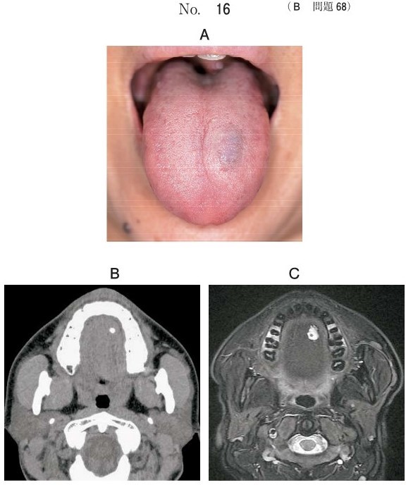 口腔内写真、CT、MRI脂肪抑制 T2強調像