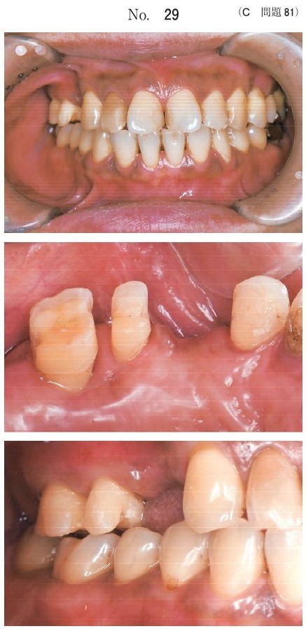 支台歯形成後の口腔内写真