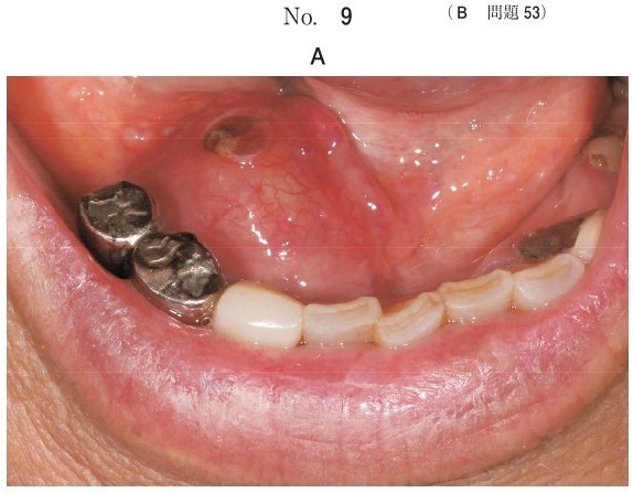 腫瘤の口腔内写真