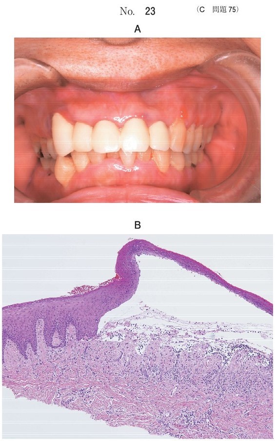 口腔内写真と生検時のΗ-E染色病理組織像