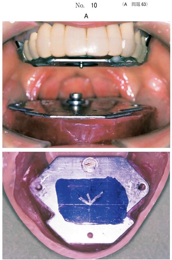 2種類の顎間関係記録装置の写真-1