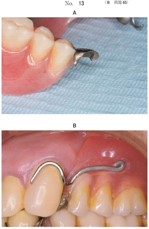 義歯の写真と再製作したクラスプ試適時の口腔内写真