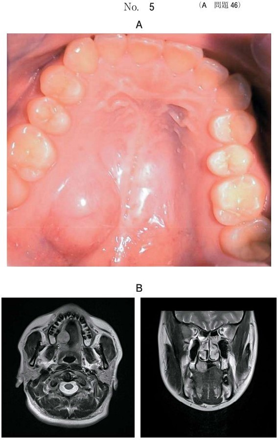 口腔内写真、MRI T2強調像