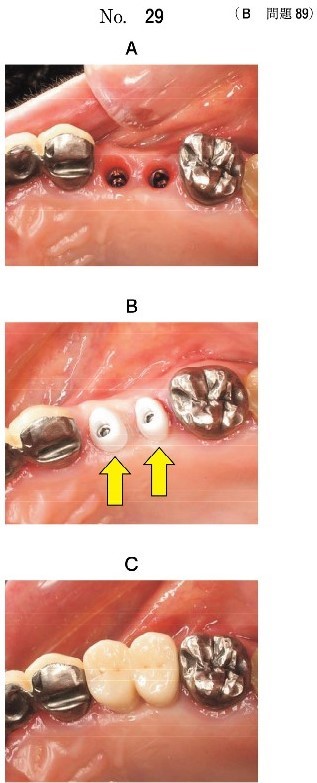 治療過程の順に並べた写真(別冊No.29A、B、C)