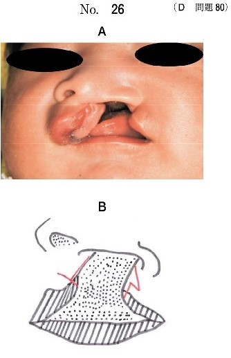 口腔内写真(別冊No.26A)と切開線を赤色で記した家族説明用の手術計画の模式図(別冊No.26B)