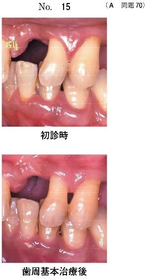 歯周基本治療後の口腔内写真(別冊No.15)
