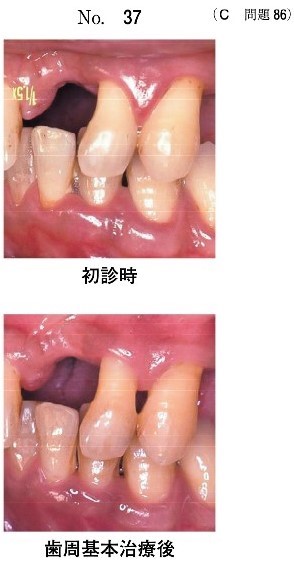 初診時と歯周基本治療後の口腔内写真(別冊No.37)
