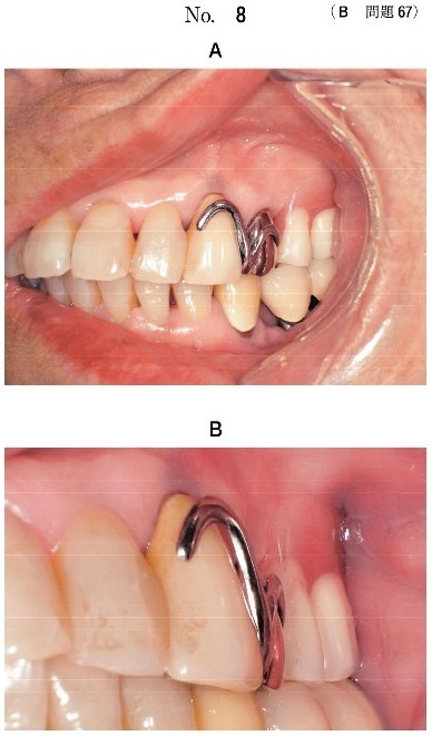 義歯装着時の口腔内写真(別冊No.8A)と上顎左側犬歯の支台装置の写真(別冊No.8B)