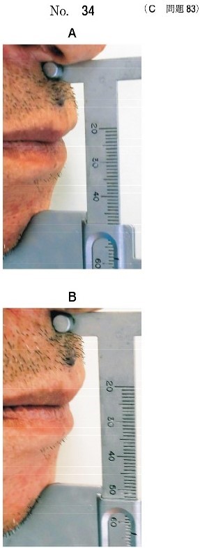 検査の写真(別冊No.34A)と下顎安静時の検査の写真(別冊No.34B)