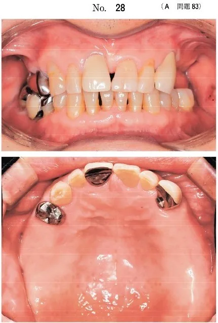 歯科医師国家試験 第111回 A83問題 | 歯科国試ドットコム