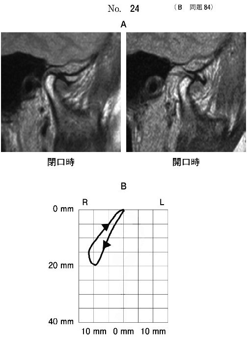 右側顎関節のMRI(別冊No.24A)と切歯点開閉口運動路を正面から観察した図(別冊No.24B)