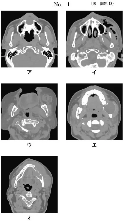 歯科医師国家試験 第111回 B13問題 | 歯科国試ドットコム