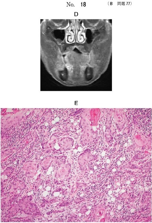 MRI脂肪抑制造影T1強調像(別冊No.18D)及び生検時のΗ-E染色病理組織像(別冊No.18E)