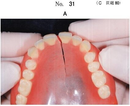 義歯の破折部を確認している写真(別冊No.31A)