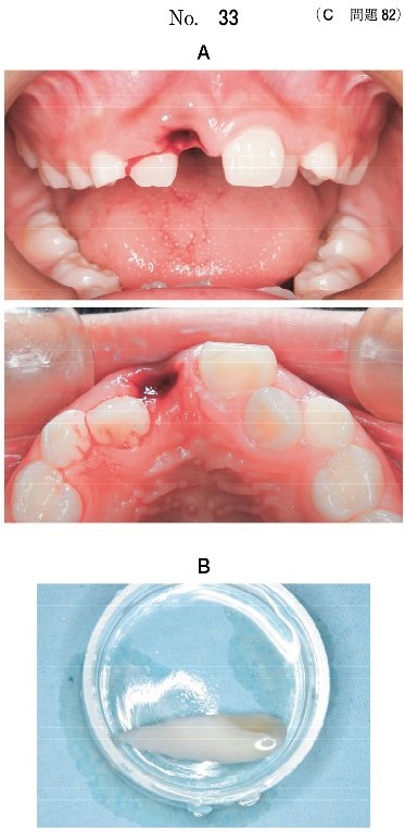口腔内写真(別冊No.33A)と持参した上顎右側中切歯の写真(別冊No.33B)