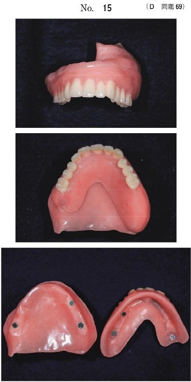 完成した顎義歯の写真(別冊No.15)
