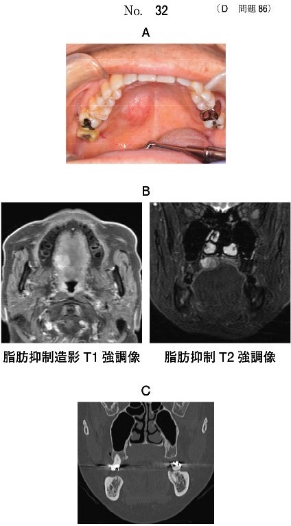 口腔内写真(別冊No.32A)、MRI脂肪抑制造影T1強調像と脂肪抑制T2強調像(別冊No.32B)、CT(別冊No.32C)及び生検時のΗ-E染色病理組織像(別冊No.32D)