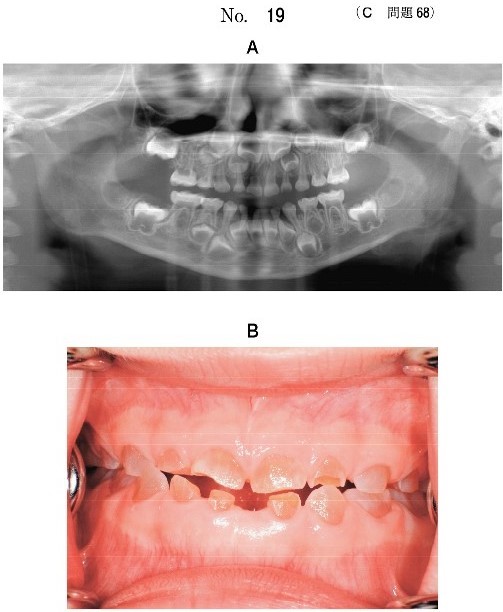 エックス線画像(別冊No.19A)と下顎左側乳中切歯脱落後の口腔内写真(別冊No.19B)
