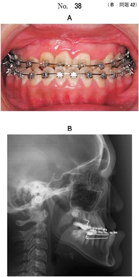 術前矯正中の口腔内写真、頭部エックス線規格写真