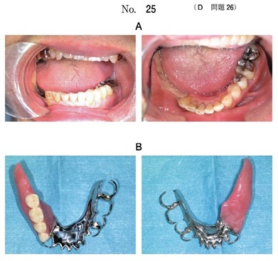 補綴治療後の口腔内写真と製作した義歯の写真