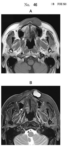 MRI T1強調像と脂肪抑制T2強調像