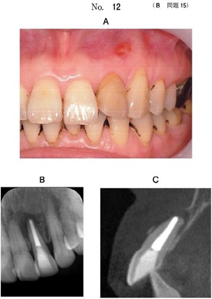 口腔内写真、エックス線写真及び追加撮影した歯科用コーンビームCT