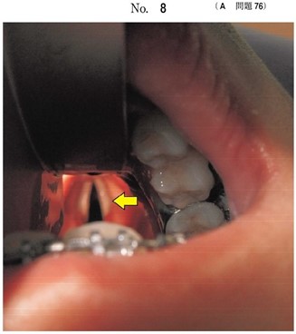 麻酔導入における喉頭展開時の写真