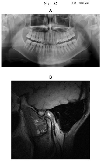 エックス線写真と開口時の左側顎関節のMRI