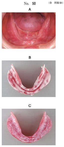 下顎顎堤部の写真と2種類の適合検査後の義歯の写真