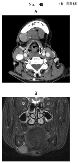 造影CT、MRI脂肪抑制 T2強調像