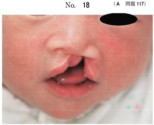 2か月の乳児の顔貌写真