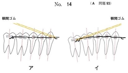 上顎前突の治療手順(ア→イ)の模式図