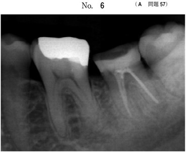 下顎左側第二大臼歯に対する根管充塡終了後のエックス線写真