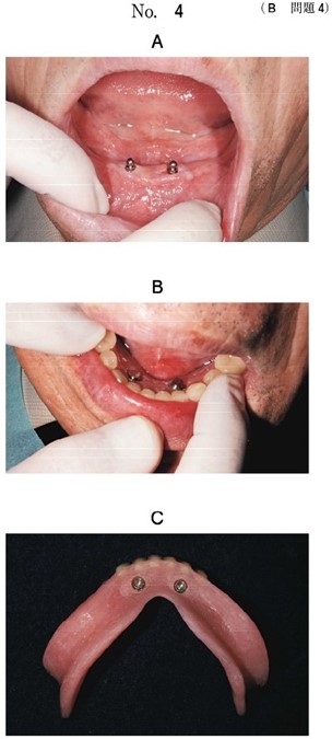 オーバーデンチャー未装着時と義歯試適時の口腔内写真