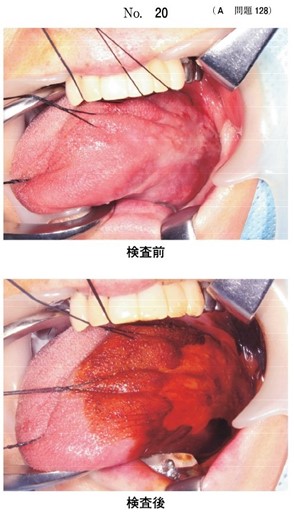 舌白板症切除手術に際して生体染色検査を行った検査前後の口腔内写真
