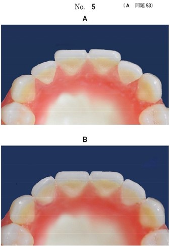 上顎全部床義歯の人工歯排列時の写真