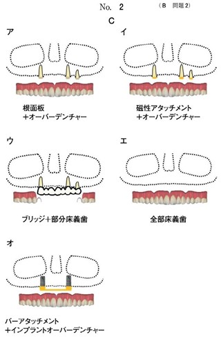 上顎の補綴治療計画の模式図