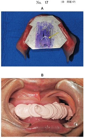 全部床義歯製作中の検査結果の写真、顎間関係記録採得時の写真