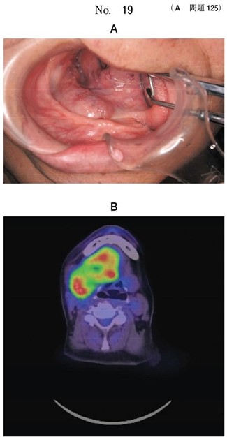口底の腫脹を主訴として来院した患者の口腔内写真