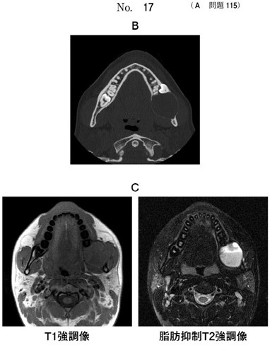 MRI T1強調像と脂肪抑制Τ2強調像