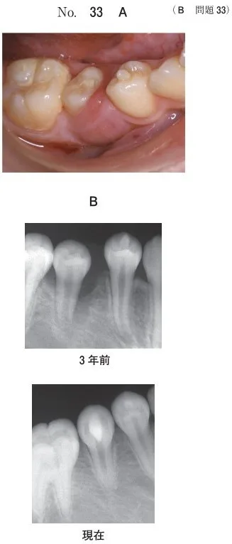 幼若永久歯の処置 | 歯科国試ドットコム