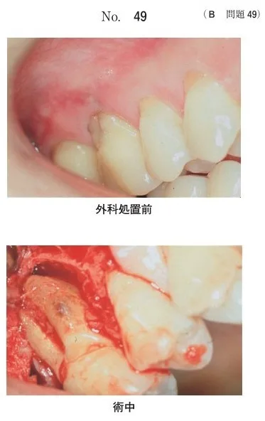 歯科医師国家試験 第108回 B49問題 | 歯科国試ドットコム