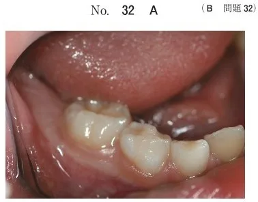 歯科医師国家試験 第108回 B32問題 | 歯科国試ドットコム