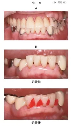 歯科医師国家試験 第117回 D40問題 | 歯科国試ドットコム