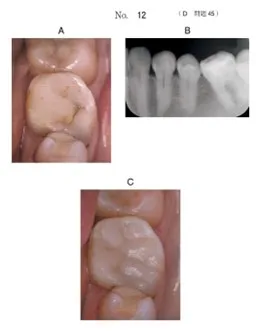 保存修復学 | 歯科国試ドットコム