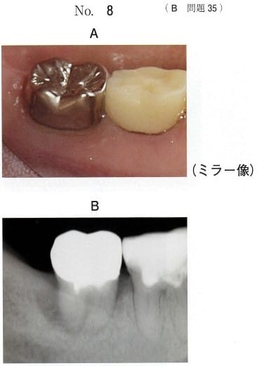 口腔内写真 (別冊No.8A)とエックス線画像(別冊No.8B)
