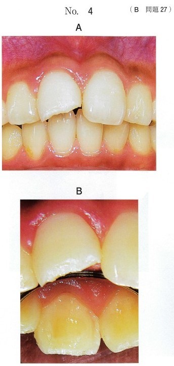 初診時の口腔内写真(別冊No.4A、B)とエックス線画像(別冊No.4C)
