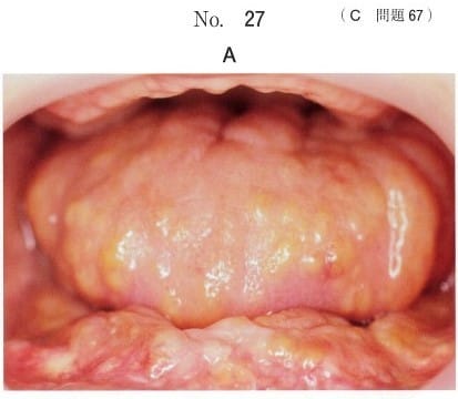 初診時の口腔内写真（別冊No.27A）