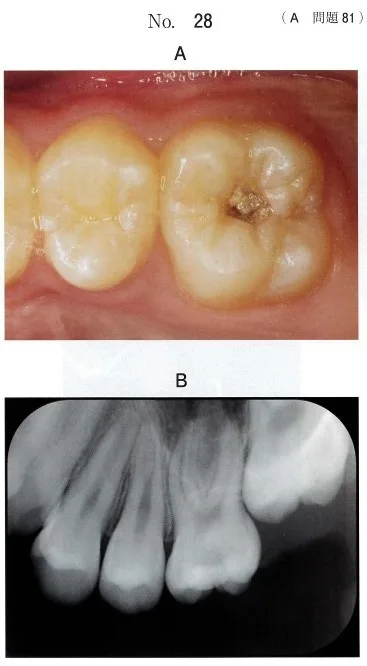 歯科医師国家試験 第118回 A81問題 | 歯科国試ドットコム