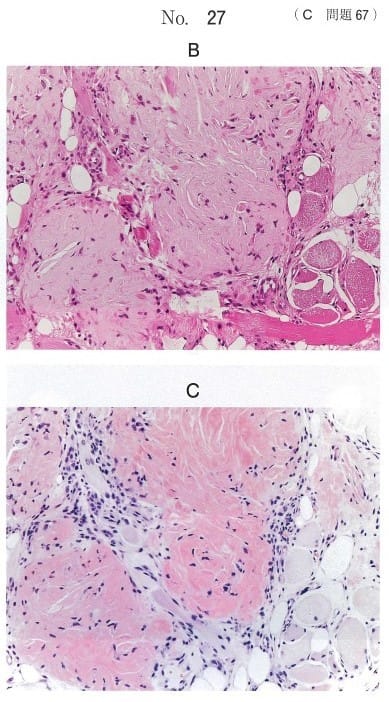 H-E染色病理組織像（別冊No.27B）及びCongo-Red染色病理組織像（別冊No.27C）